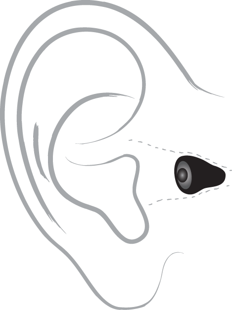 Technical drawing of an in-ear hearing aid positioned within a human ear outline.